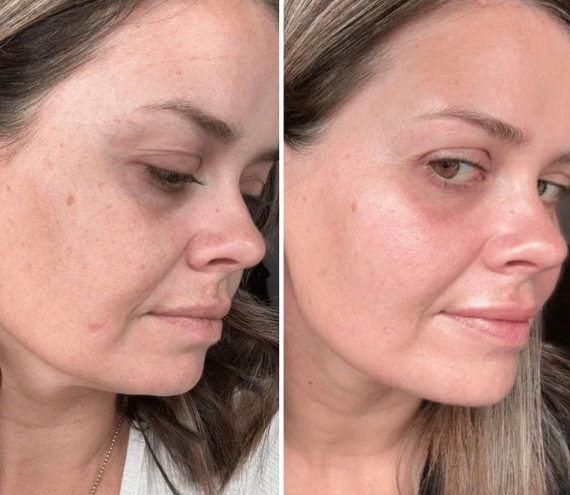 Before and After